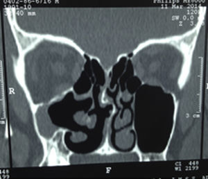 Single coronal section of CT scan showing asymmetry of both maxillary sinuses, with collapsed right maxillary sinus, hypoglobus and anomalous implantation of the middle concha.