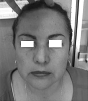 Clinical photograph of the patient with mild facial asymmetry at the expense of the left hypoglobus.