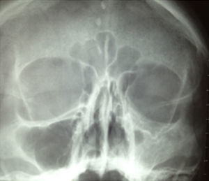 Single Waters view radiograph showing asymmetry with hyperdensity at the level of the left maxillary sinus with bone reinforcement and hypoglobus.