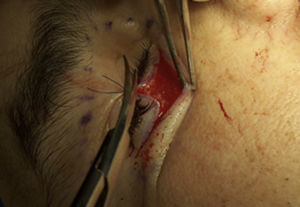 Transurgical photograph of the subciliary approach and dissection of the orbital rim.