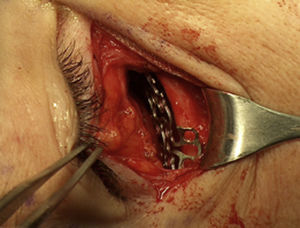 Transurgical photograph showing the placement of the titanium plate prior to fixation with screws for correction of double vision.