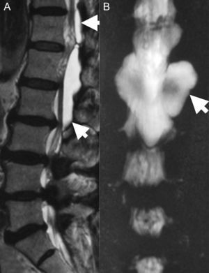 (A) T2-weighted magnetic resonance image showing an isointense cystic lesion with cerebrospinal fluid (arrows) of T12 to L2. (B) Myelographic effect on magnetic resonance image; the communication (arrow) between the arachnoid space and the cystic lesion is apparent.