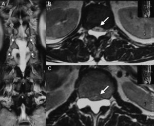 (A) T2-weighted coronal section magnetic resonance image showing the foraminal extension of the cyst (asterisk) in T12-L1 and L1-L2. (B) T2-weighted axial section magnetic resonance image of level T12 showing ventral displacement of the conus medullaris (arrow) caused by the cyst. (C) T2-weighted axial section magnetic resonance image of level L1 showing compression of the cauda equina (arrow) caused by the cyst.