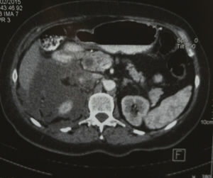 Collection of retroperitoneal fluid, dilated cystic duct.