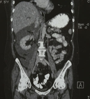 Computed axial tomography: coronal section, abundant perirenal fluid.