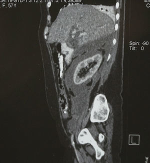 Computed axial tomography: sagittal section, perirenal fluid.