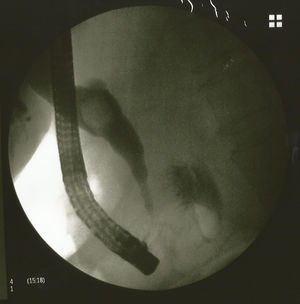 Retrograde endoscopic cholangiopancreatography: dilated cystic duct with a large stone inside.