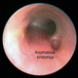 Bronchoscopy showing the tracheal bronchus emerging above the carina.