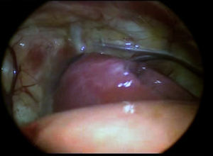 Appearance of the apical lobe at the time of initial thoracoscopic exploration.