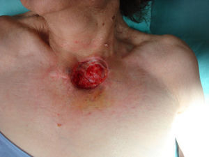 Surgical defect after SCC excision with margin, left open until the histopathological report. When this returns tumour-free, the wound will be closed.