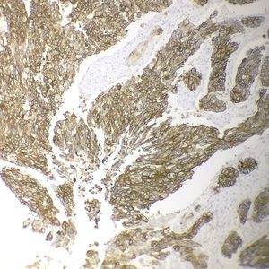 Strong and complete membranous expression of HER2(3+) in a poorly differentiated intestinal-type adenocarcinoma (immunohistochemistry, 200×).