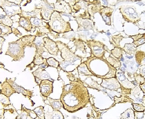 Analysis with immunohistochemistry of HER2 overexpression(3+) in a poorly differentiated carcinoma with signet ring cells (400×).