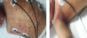 (A,B) Disseminated erythematous violaceous rash and visceromegalies.