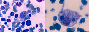 Bone marrow aspirate. Hemodiluted sample, without blasts, without foreign cells and with activated lymphocytes. Some histiocytes with hematophagocytosis are shown.