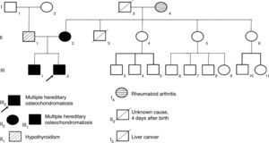 Family tree. The mother and two sons are cases of multiple hereditary osteochondromatosis.
