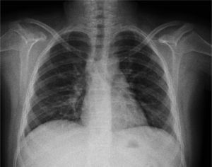 Lymphadenopathy and pulmonary infiltrates remission after treatment.