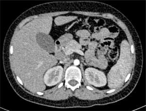 Abdominal computed tomography after treatment: retroperitoneal lymphadenopathy remission and kidney stone disappearance.