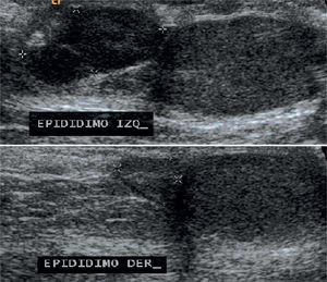 Testicular ultrasonogram: left epididymis is enlarged in comparison to the right one.