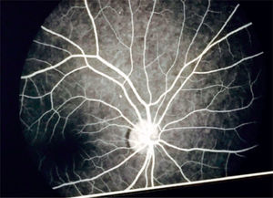 Retinal fluorangiography: normal vessels.