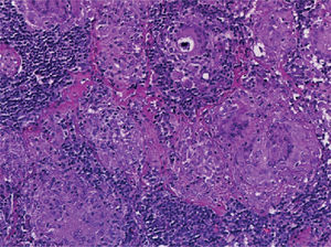 Lymph node biopsy with non-caseating granulomas.