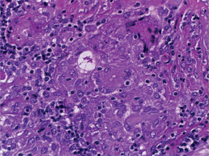 Lymph node biopsy with asteroid bodies.