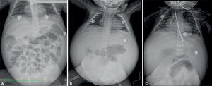 Simple thoracoabdominal X-rays. A. Displaced bowel loops. B. Horizontalization of ribs. C. Enlarged heart cavities.