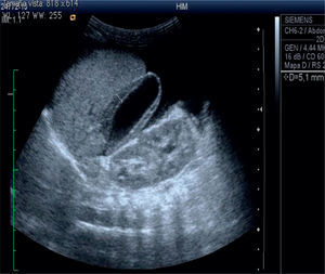 Liver ultrasound showing increased echogenicity, peritoneal fluid collection and distended gallbladder with thickened walls.
