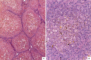 A. Photomicrograph showing regenerative nodules surrounded by thin bands of fibrosis (Masson 50X). B. Hepatocytes with cytoplasmic vacuolation and cholestasis. There is cholangiole proliferation in the periphery of regeneration nodules (HE 100X).