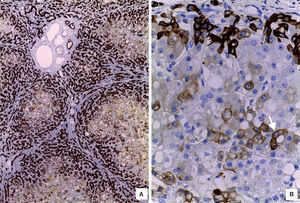A. Cholangiole proliferation with expression of CK7 at the periphery of the lobule. B. Regeneration nodule with aberrant expression of CK7 in hepatocytes (arrow). Cholangioles highlighted by cytoplasmic expression of CK7 (IHC).