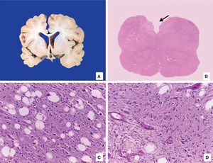 A. Enlarged lateral ventricles with data of cerebral parenchyma atrophy. B. Medulla with areas of encephalomalacia (arrow). C. Neuropil vacuolation and loss of myelin. D. Vascular proliferation.