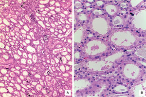 A. Panoramic photomicrograph showing a nodular pattern of the renal cortex with enlarged tubular lumen and calcifications (HE 100X). B. Proximal tubules with cytoplasm vacuolation and lumen dilatation (HE 400X).
