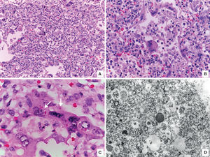 A. Lung with viral pneumonia signs. B. Alveoli are lined by giant multinucleated cells and there is lymphocytic infiltrate in alveolar septa. C. Giant multinucleate cell with eosinophilic cytoplasmic inclusions (arrows). D. Electronic microscopy showing filamentous inclusions compatible with respiratory syncytial virus.