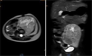 Contrasted abdominal MRI is showing a solid mass of 107 x 80 x 76mm in its craniocaudal, anteroposterior and transverse diameters, which occupies hypogastrium, left iliac fossa, left flank and mesogastrium. It is pedunculated and comes from left L4-L5 and L5-S1 intervertebral foramina. It is solid, heterogeneous, vascularized, with necrosis. It partially surrounds the aortic bifurcation and totally the left iliac artery and its branches, so as the iliac vein.