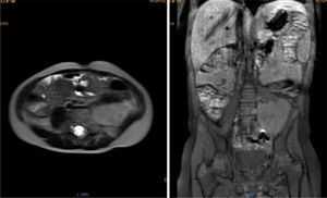 Contrasted abdominal MRI is showing a left paravertebral, well-defined mass of heterogeneous appearance in all sequences. The lesion measures about 42.2 x 53.6mm and has avid contrast enhancement.