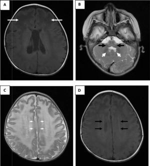 Brain magnetic resonance imaging. A. Enhanced image in axial projection spin-echo (SE) in T1 where arrows indicate extensive white matter changes of frontal predominance. B. White matter signal alterations of the cerebellum, dentate nucleus and brainstem in a fast SE (FSE) T2 enhanced image. C. Hyperintense rim in the axial projection in FSE T2. D. Hypointense rim in the axial projection in T1.
