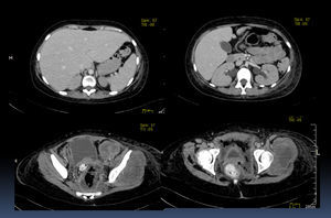 CT scan with contrast medium where hepatomegaly and bilateral hydronephrosis were found. The tumor is present in the lower layers.