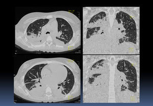 Pleural effusion on the right side, air bronchogram and bilateral basal consolidation of right dominance ganglion conglomerates were observed in the lung and mediastinum.