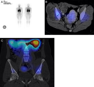 A. Fusion SPECT/CT study. B. The part of the left iliac bone with an increased uptake can be observed. C. No uptake areas related to necrosis are observed.