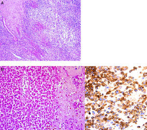 Histological appearance of neoplasia. A. Round cells with round nuclei and hyperchromatic and scarce cytoplasm. B. Areas of necrosis and cell ghosts. C. Intensely positive CD 99 antibody by immunohistochemistry.