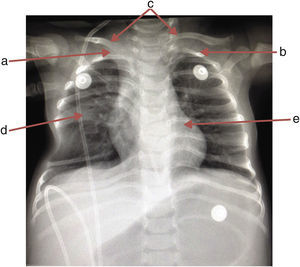 Anteroposterior chest x-ray that shows the absence of the right first rib (a), left first rib hypoplasia (b), aberrant insertion of both clavicles (c), sixth and seventh costal arch fused in the right hemithorax (d) and T6 and T7 butterfly vertebra (e).