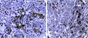 A. Epithelial immunomarkers tested positive in the areas of gland formation (cytokeratin 7). B. The solid component presents an endocrine differentiation, which is evident with the endocrine markers (chromogranin).