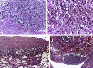A. The gastric wall is infiltrated by a poor differentiated neoplasm. B. The production of mucosubstances is intracellular, which originates the so-called signet-ring cells. Tumor dissemination was extensive both lymphatic and hematogenous. C. The pleura is compromised and focally the lung parenchyma. D. The pelvic soft tissues show infiltration by the neoplasm; the serosa of a salpinx is observed.