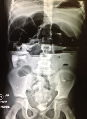 An erect plain abdominal film. Significant distention of the small bowel intestinal loops and air-fluid levels.