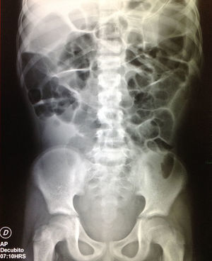 An abdominal AP supine radiograph. A decrease of the colon dilatation and small bowel gas is observed, but liquid in the topography of the ascending colon and rectum persists. A nasogastric tube is observed at the level of the epigastrium.