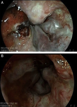 A. Post-sclerotherapy ulcer with active bleeding. B. Site of bleeding.
