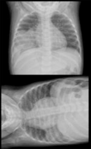 Anteroposterior chest X-ray and with horizontal projection.
