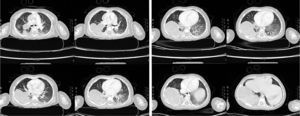 Contrasted chest CT scan, pulmonary window.