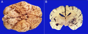 A. The base shows a tumor that bilaterally increases the volume of the pons. The tumor is light yellow and solid in appearance. B. Coronal sections of the brain show a poorly delimited neoplasm of yellow color with areas of necrosis and hemorrhage and loss of parenchyma affecting the gray nuclei of the right side base.
