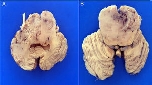 Transverse sections of the brain stem show a bilaterally infiltrating neoplasia with increased pons, midbrain and bulb volume.