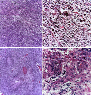 Glioblastoma is a highly cellular glial neoplasm (A) composed of poorly differentiated, pleomorphic cells with abundant atypia and mitosis. There may be multinucleated elements (B). There are areas of necrosis that may vary in size; are characteristically surrounded by viable tumor cells in the periphery, delimiting them, and forming a palisade (C). There is vascular proliferation with vascular wall hyalinization and glomeruloid appearance (D).